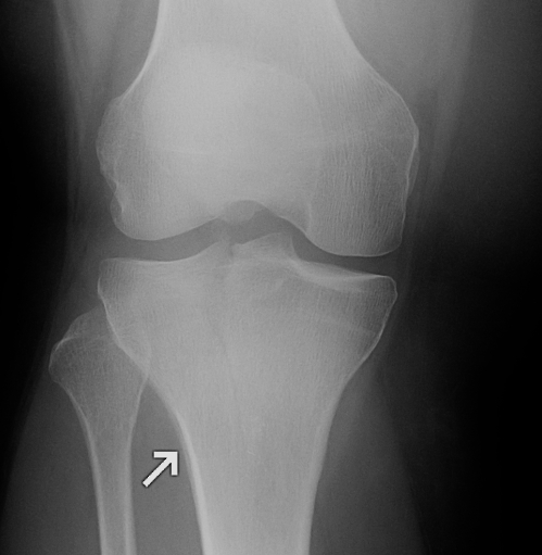 Tibial Plateau Schatzker 1